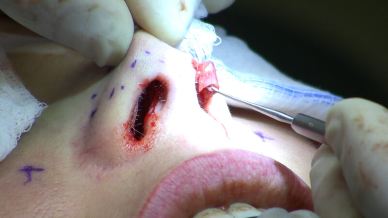 Exposing lower lateral cartilage during rhinoplasty